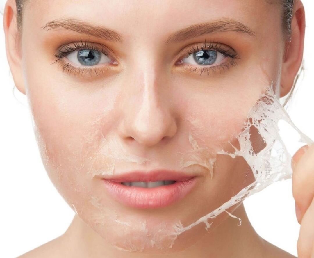 снятие верхнего слоя кожи после пилинга.