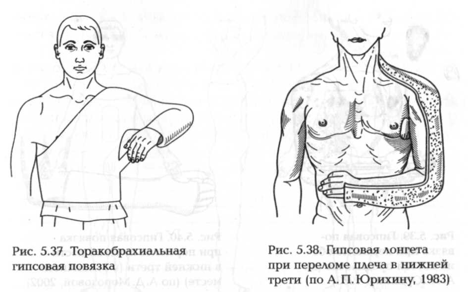 Значение словосочетания «гипсовая повязка»