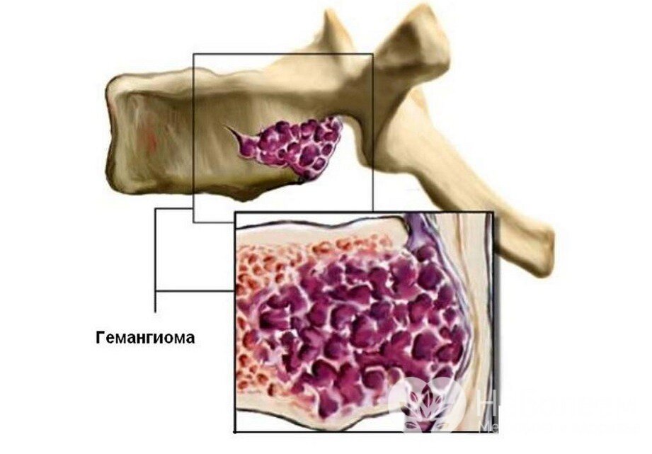 Гемангиолипома в теле позвонка что это такое
