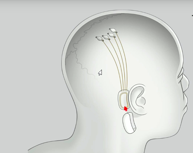 Схема будущего соединения мозга человека с внешними устройствами. Фото отсюда   https://www.dezeen.com/2019/07/22/elon-musk-neuralink-implant-ai-technology/ 