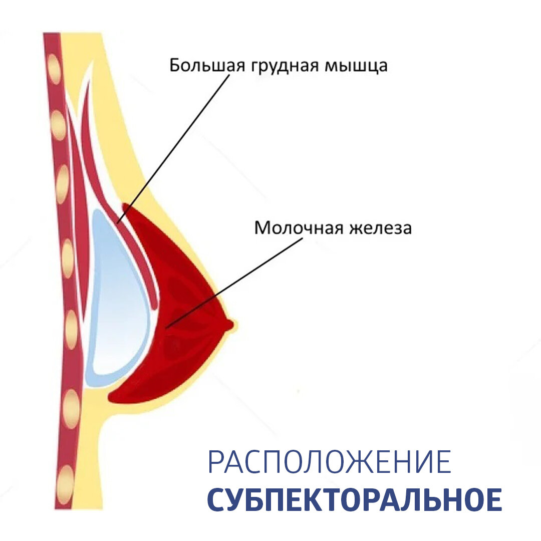 Рак молочной железы