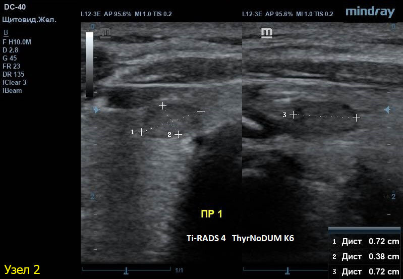 Кальцинаты в щитовидной железе. УЗИ щитовидной железы микрокальцинаты. Макрокальцинаты щитовидной железы на УЗИ. Микрокальцинаты в щитовидной железе на УЗИ. Перешеек щитовидной железы на УЗИ.