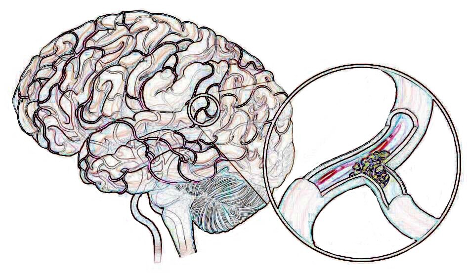 Инсульт-нарушение кровоснабжения участка мозга в следствие разрыва сосуда или его закупорки тромбом.