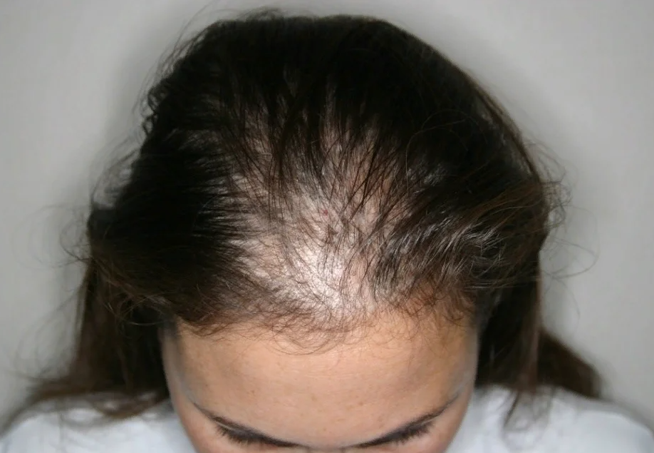 Вот к чему может привести постепенное выпадение волос.