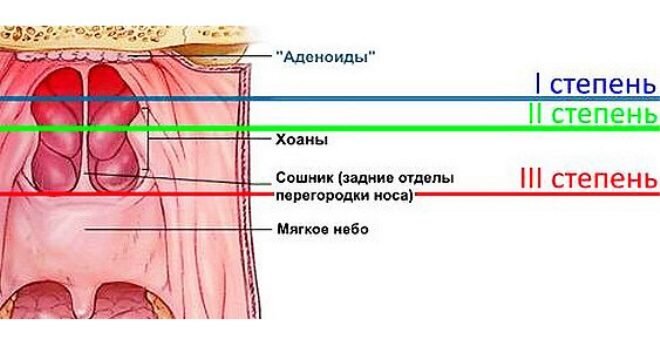 Увеличение или разрастания аденоидов (носоглоточный миндалины) можно считать одной из самых частых проблем в детском возрасте., особенно при значительной степени разрастания лимфоидной ткани.-2