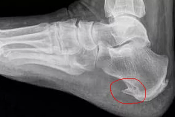 Наступая, каждый раз вырост травмирует периост, который травмируется, воспаляется. 