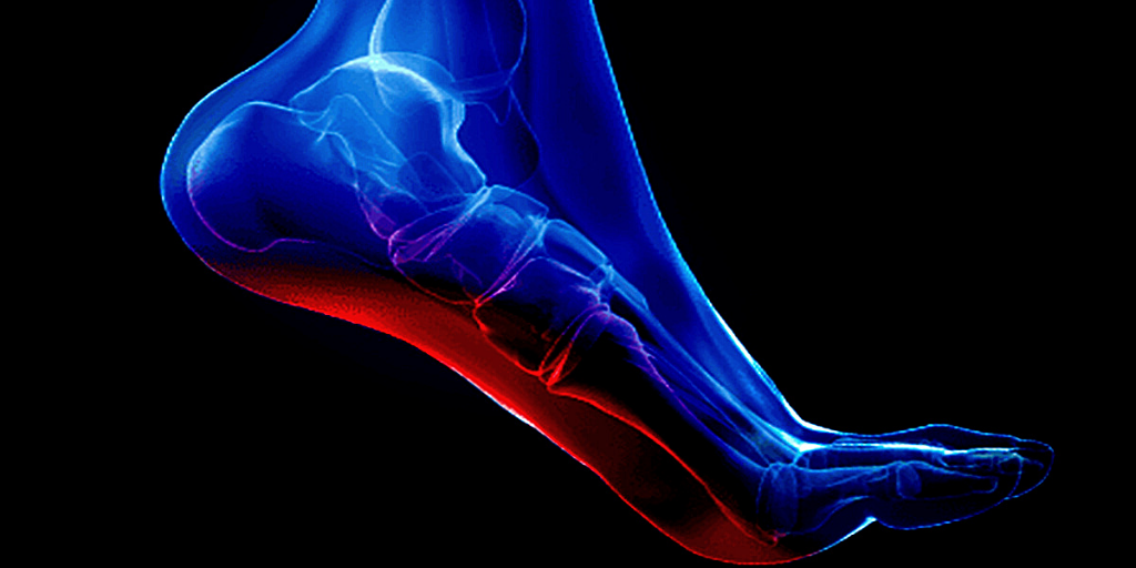 Воспаление подошвенной фасции.