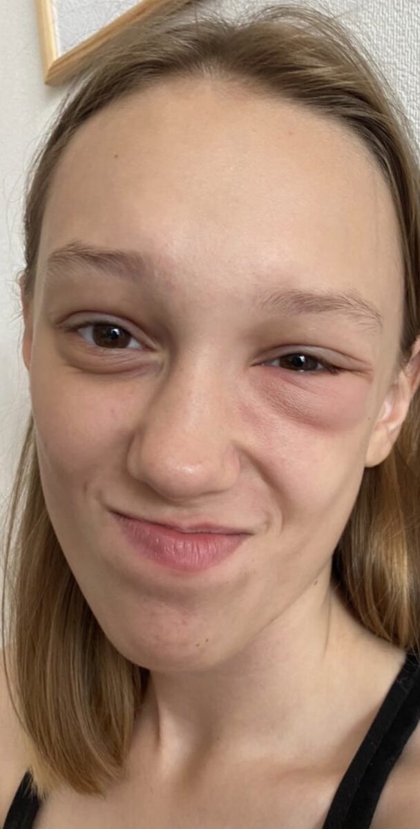 Глаз на следующее утро 