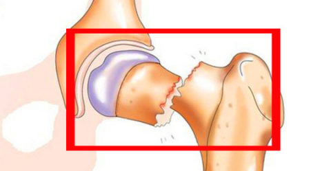  Особенности переломов шейки бедра в пожилом возрасте