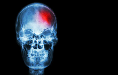  
 По данным Американской ассоциации по области сердца, каждый год более 100 000 женщин в возрасте до 65 лет случается инсульт.