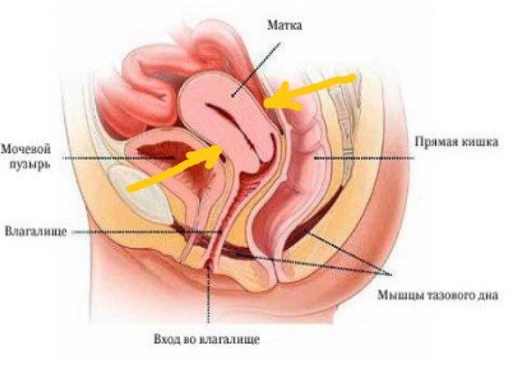 Уменьшение входа во влагалище