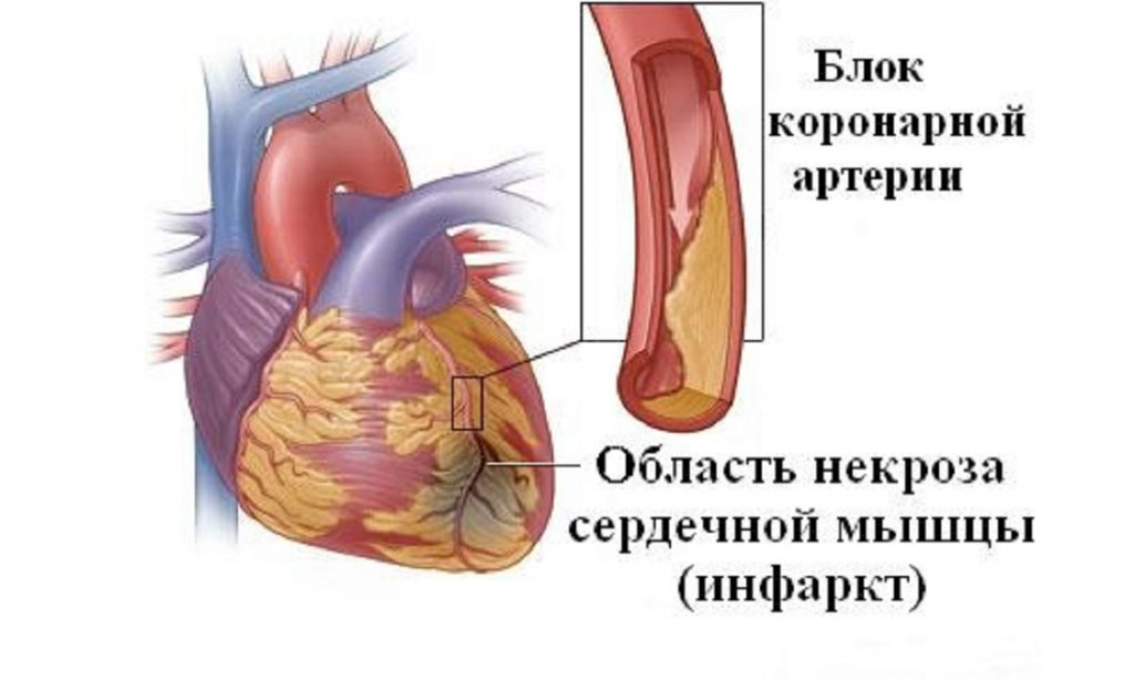 Что такое инфаркт миокарда. Инфаркт миокарда рубец. Инфаркт миокарда (некроз миокарда). Омертвение сердечной мышцы. Некроз сердечной мышцы.