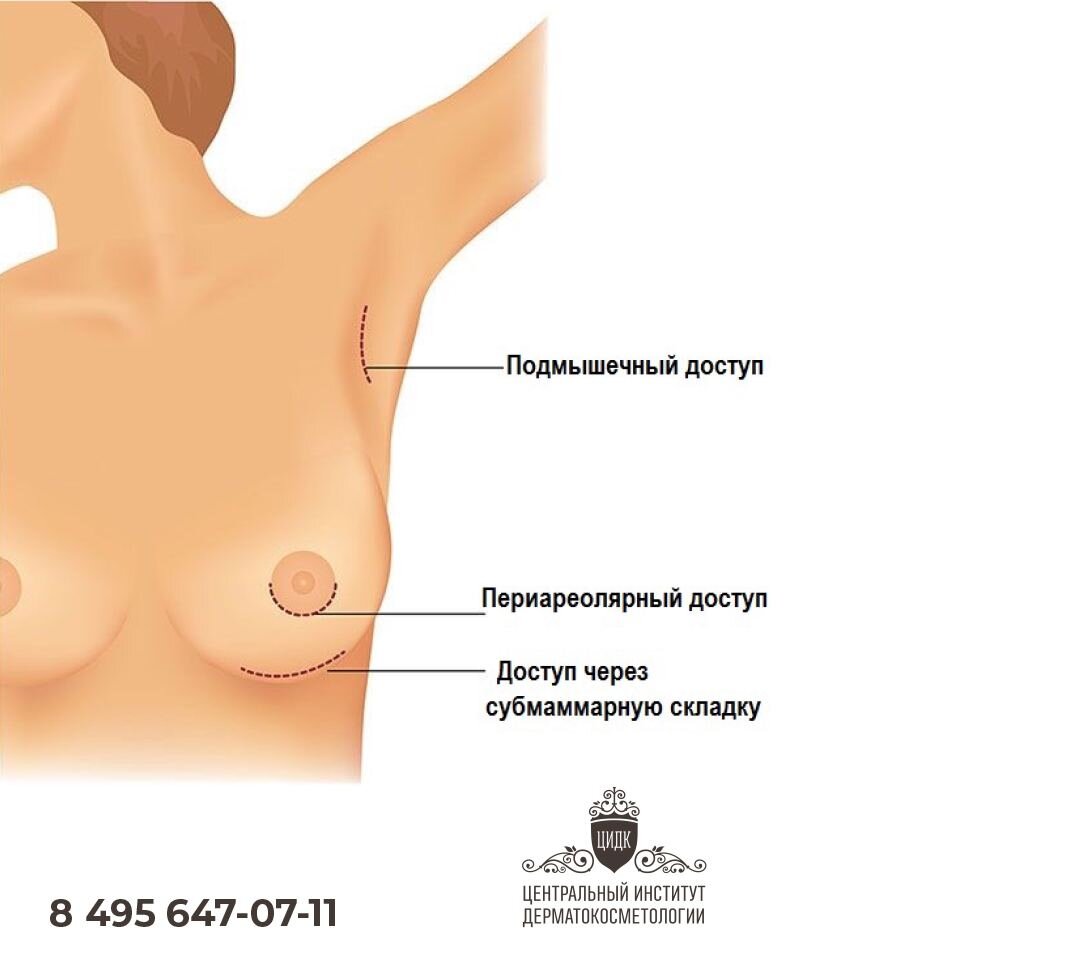 Замена имплантов груди