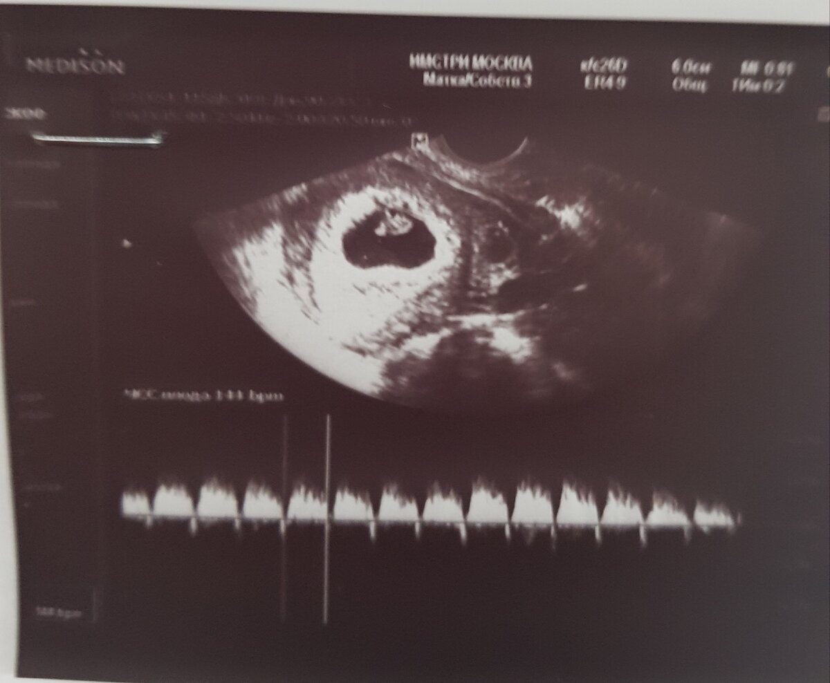 Личное фото из архива, плодное яйцо с эмбрионом, срок 7-8недель.   