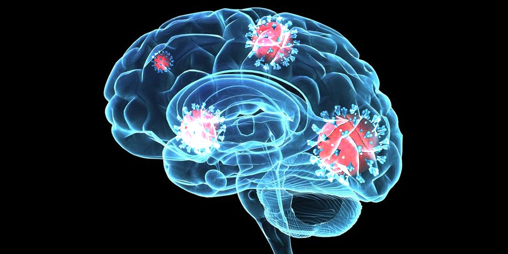 Когнитивные нарушения после перенесенного COVID-19