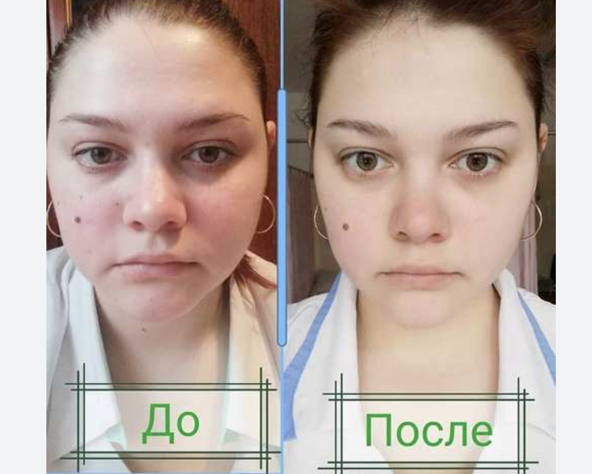 Драйн эффект до и после. Эффект от драйнэффект. Драйн эффект НЛ до после. Draineffect до после.