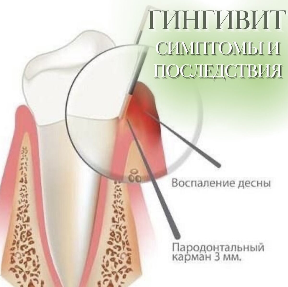 Гингивит – лечение в Тольятти