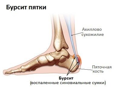 Ахиллобурсит - лечение, симптомы, причины