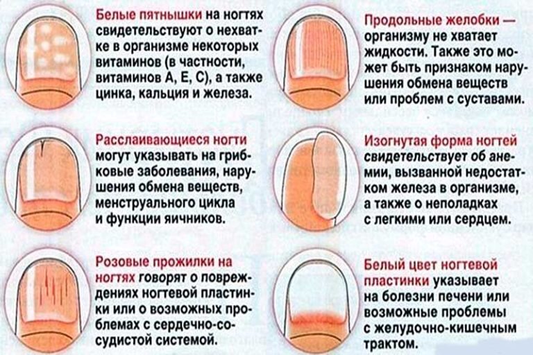 Дерматолог объяснила, из-за чего на ногтях появляются белые пятна