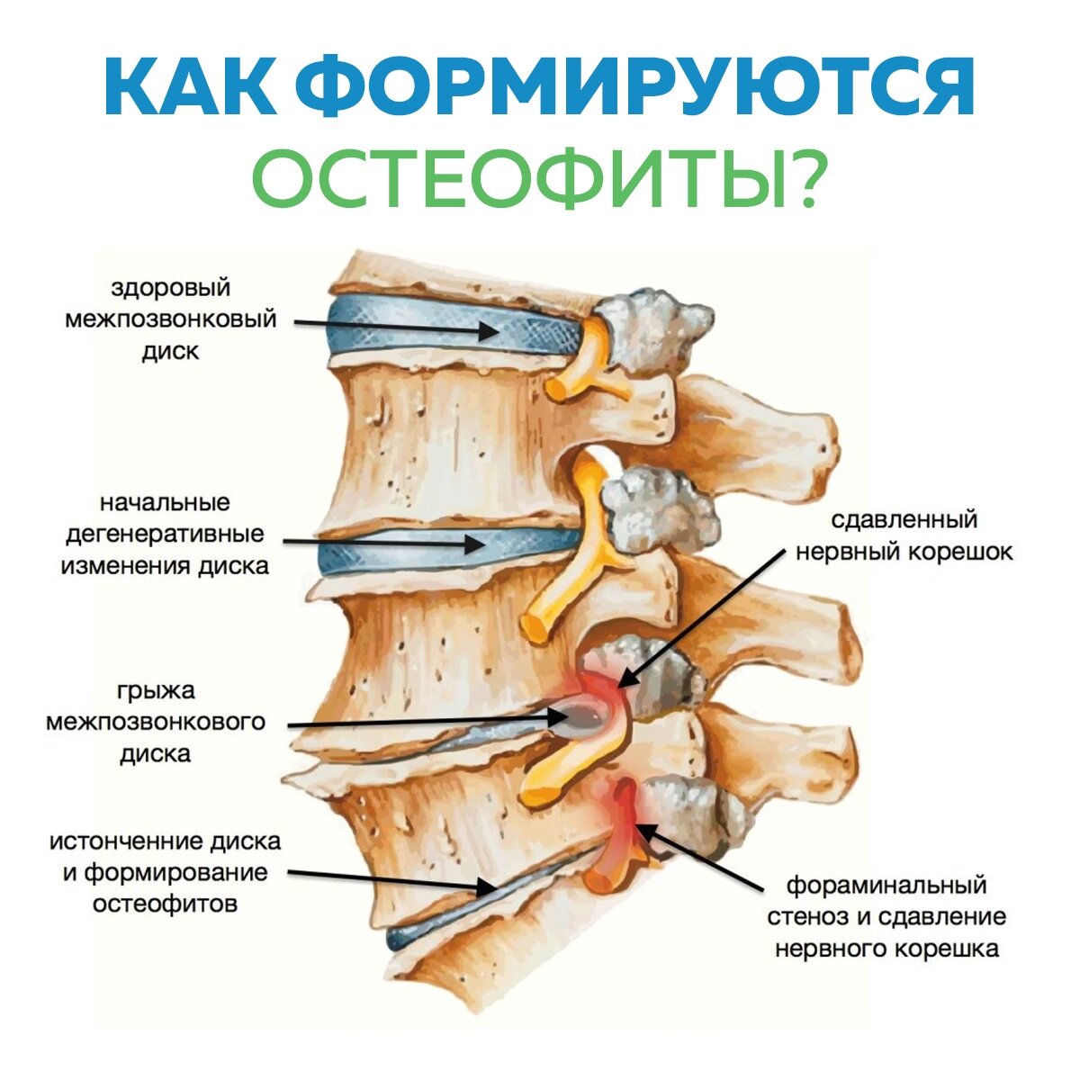 План лечения грыжи позвоночника