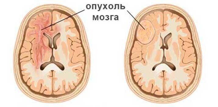 Почему эко вызывает рак головного мозга. Менингиома серпа мозга. Опухоль головного мозга фото. Мозговая опухоль симптомы.