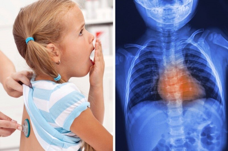 Острый бронхит у детей.