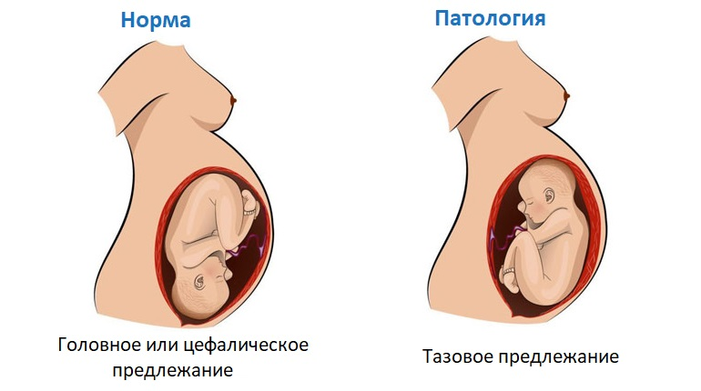Предлежание плода 32 недели. 32 Неделя беременности головное предлежание. Тазовое предлежание ребенка на 32 неделе беременности. Ребёнок 32 неделя беременности тазовое предлежание плода. Головное предлежание плода при беременности на 30 неделе.