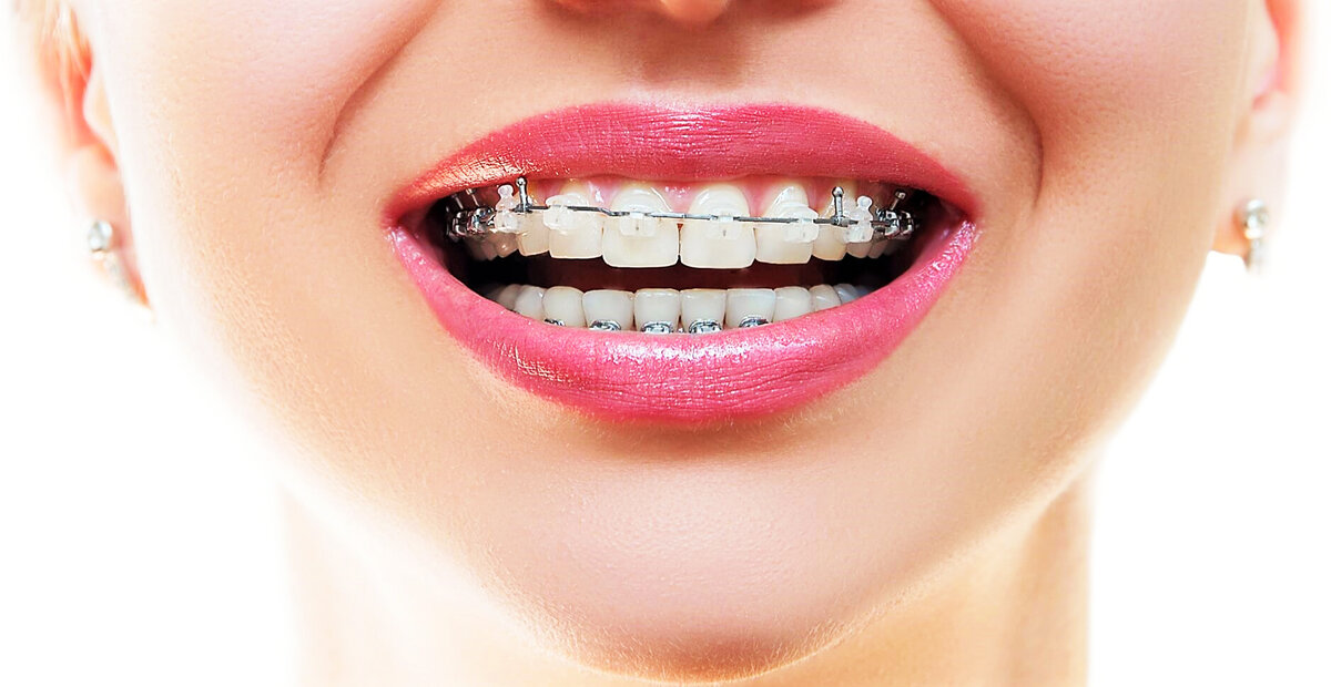 Чистка зубов с брекетами, требует более обширного арсенала. 