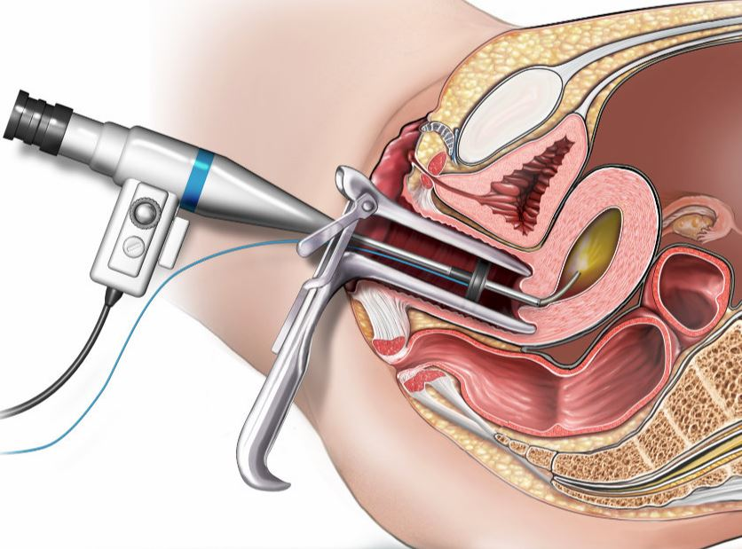 Гистероскопия с РДВ