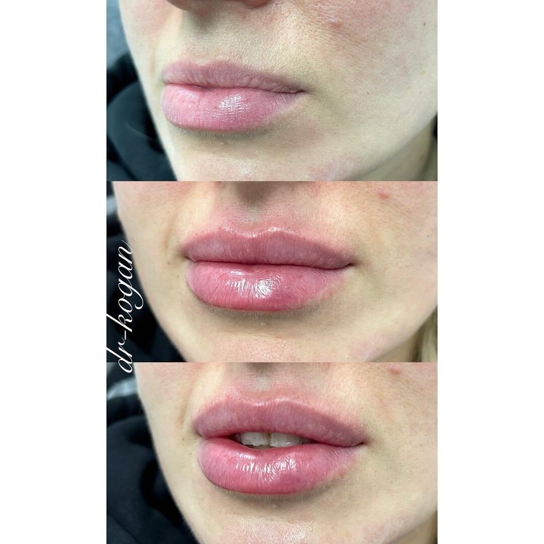 Объемные губы макияж. Через сколько можно красить губы после. Перманент губ контур с растушевкой. Через сколько можно красить губы после. Через сколько можно красить губы после.