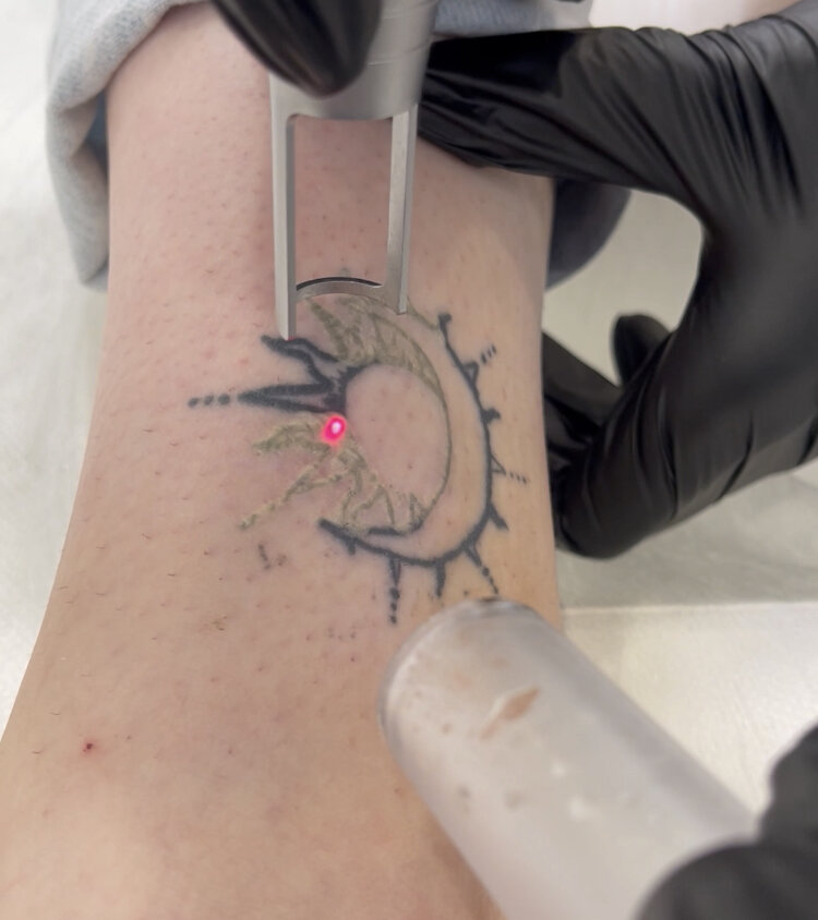 Лазерное удаление татуировок - цена в клинике в Санкт-Петербурге