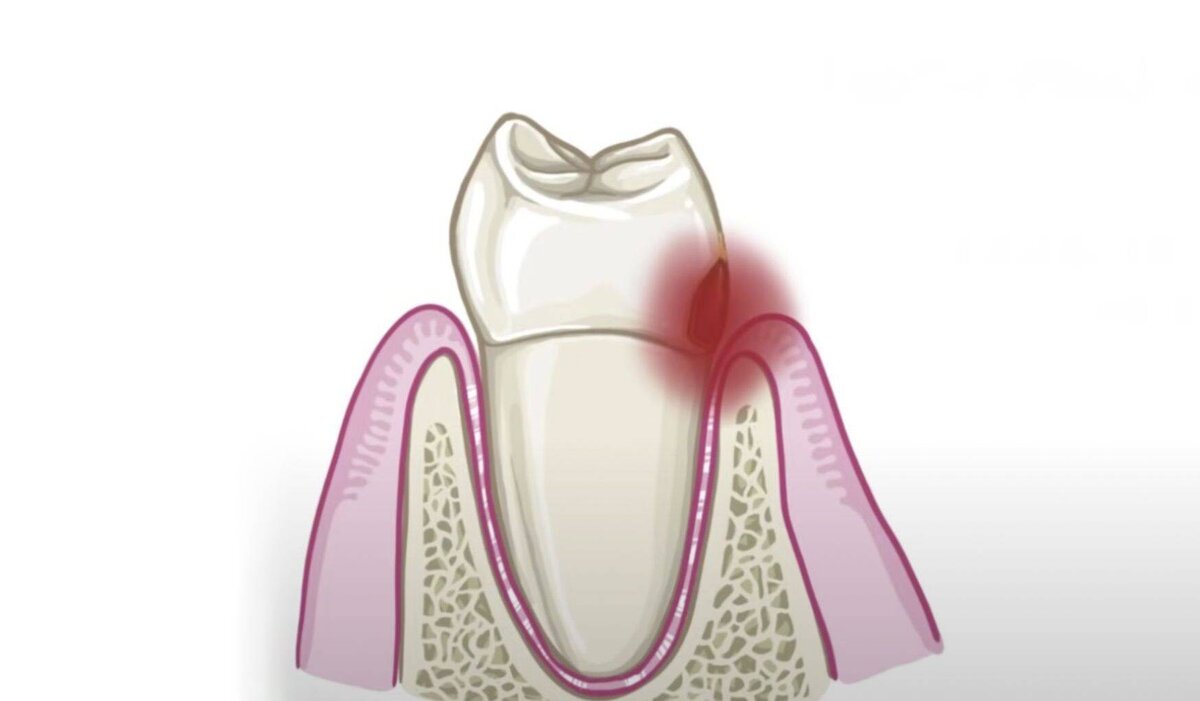 Анимация зубной боли. Фото от автора. 