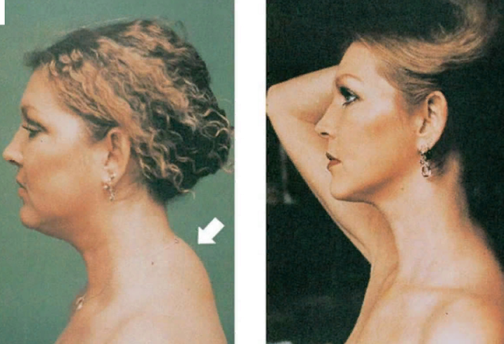 Нарост на шее