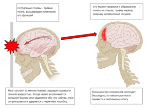 Сотрясение мозга: современные методы лечения