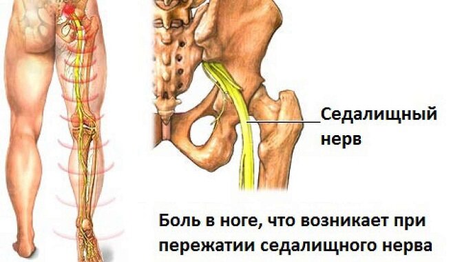 Как вылечить защемление нерва в спине?