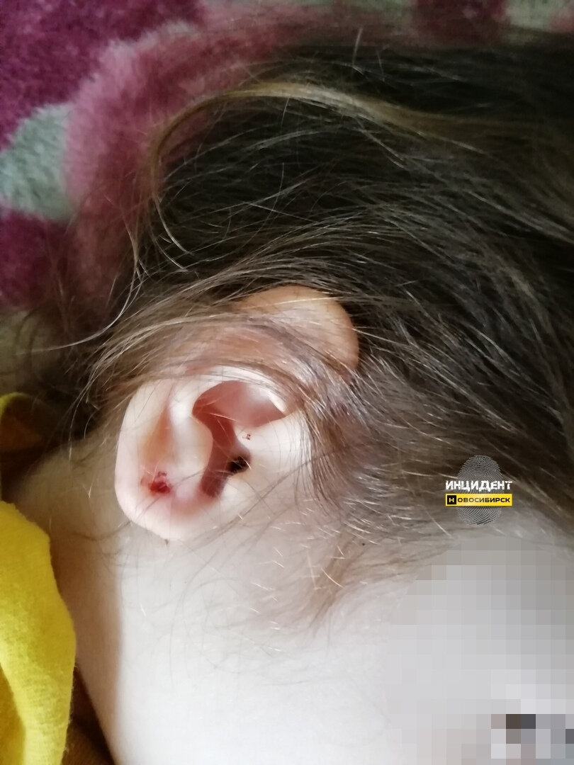 Фото в открытом доступе. Примерно так же выглядело ухо моей дочки