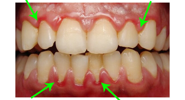 Воспаление десны - гингивит.
