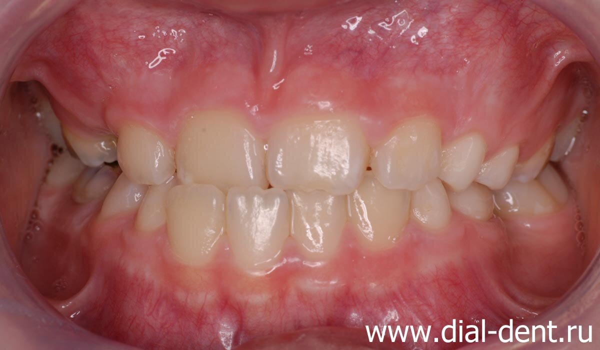 перекрестный прикус у ребенка - нижние зубы выступают перед верхними