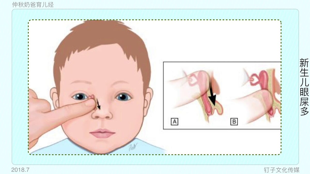 Что делать, когда у ребенка закисают глаза? | Visiobud