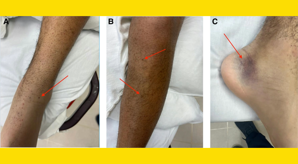   Newsom et al. / BMJ Case Reports, 2023
