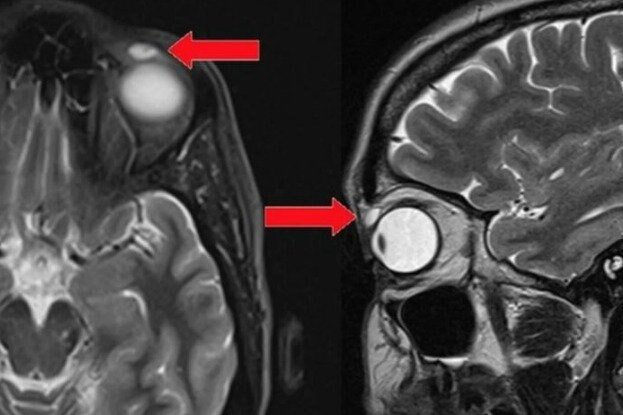     Что будет, если не снимать контактные линзы 28 лет: реальная история