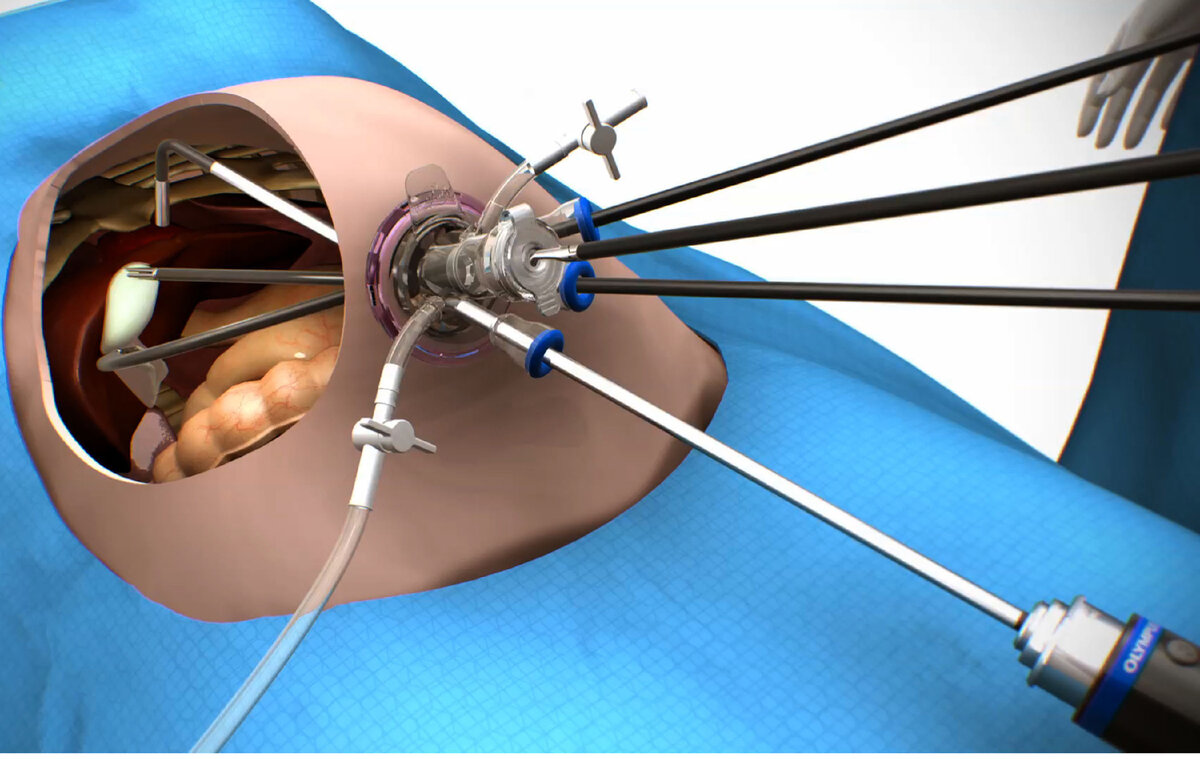 Лапаротомия лапароскопия холецистэктомия. Лапароскопическая холецистэктомия Sils. Лапароскопия холецистэктоми.