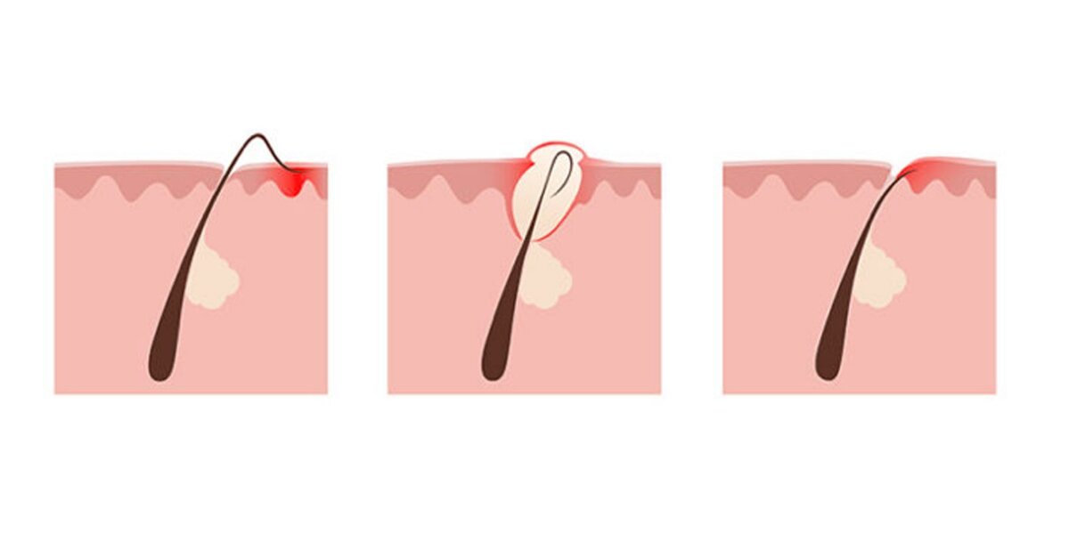Как удалять волосяной покров с полового органа