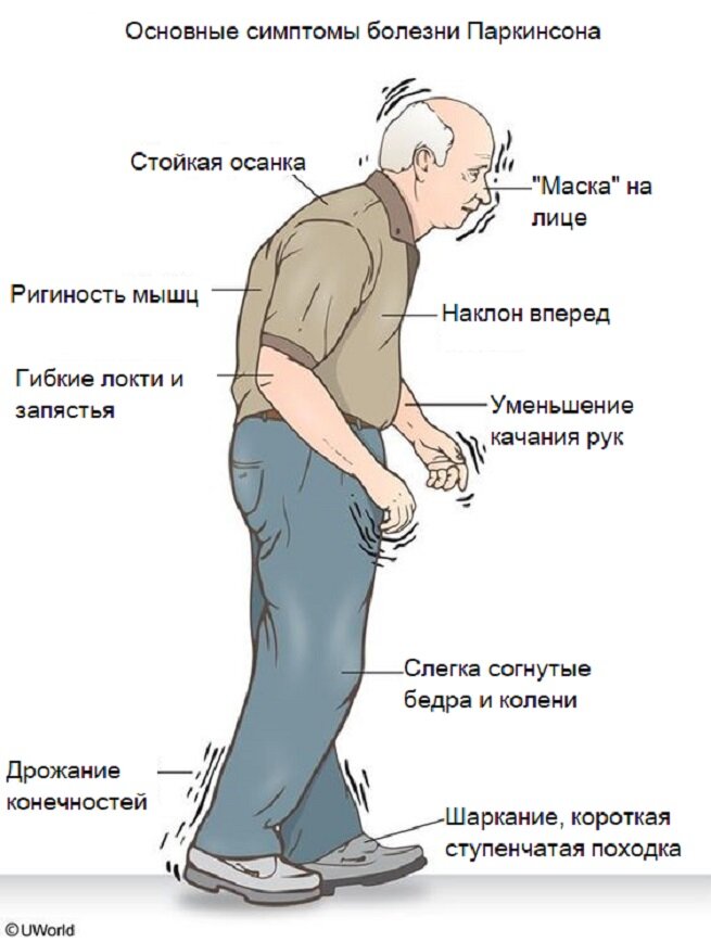 Лечение болезни Паркинсона