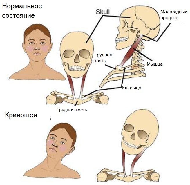 Ребенок отлежал головку