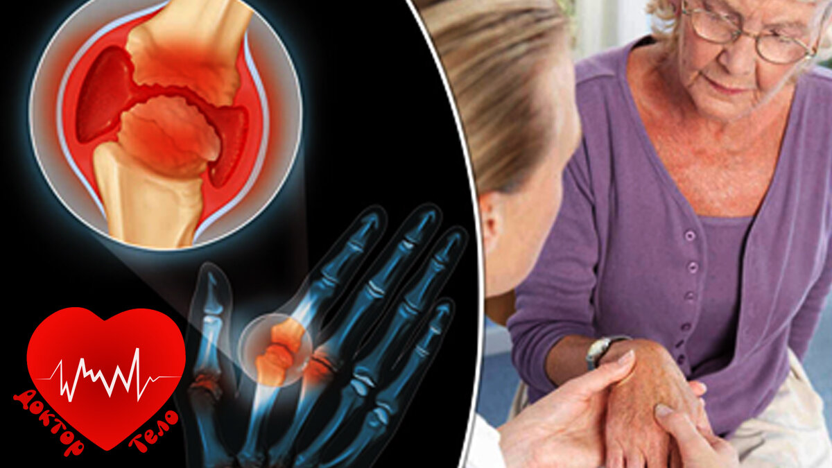 суставы. болезнь суставов. лечение суставов.