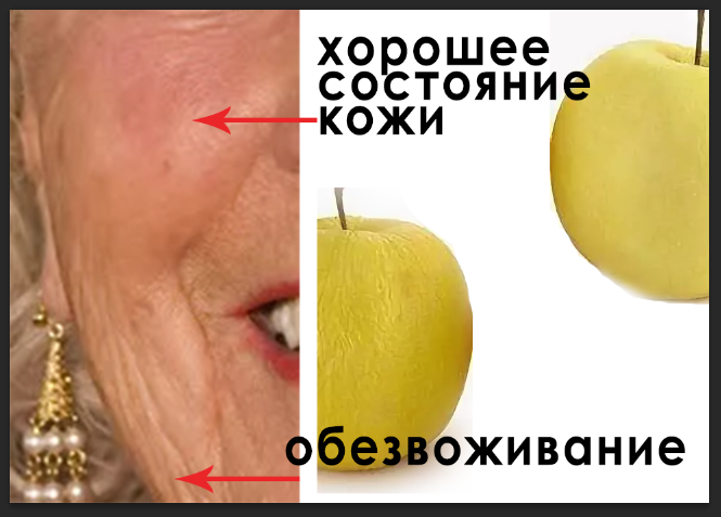 Обезвоженная кожа сморщивается как вялое яблоко. Там, где мышца большая, кровоснабжение хорошее, кожа лучше. Там где участок мышц, которые больше подвержены перенапряжению, больше мелких мышц состояние их хуже, кожа недополучает питания.