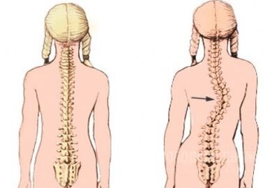 нормальный позвоночник ---------------> сколиоз