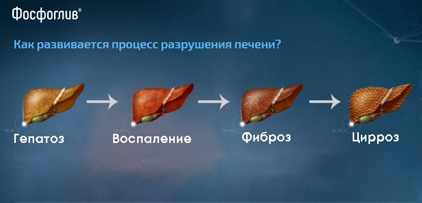 Запущенный фиброз может привести к циррозу. Тогда в печени происходят необратимые изменения, и она перестает нормально работать