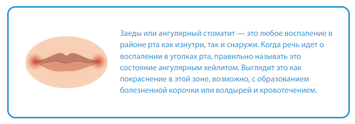 Трещины и заеды в уголках губ: причины и лечение — EVO